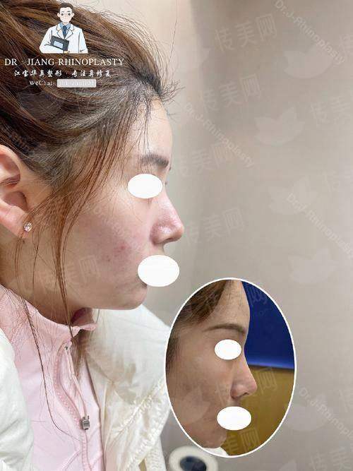 新疆奎屯优兰卡医美的鼻修复，案例多效果好，了解价格后马上预约享受服务！