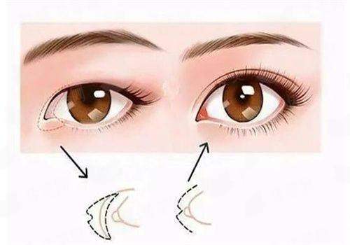 哇塞！武汉紫荆医院医疗美容科成均祚眼修复效果绝了，术后宛如天生美眼！附医院地址