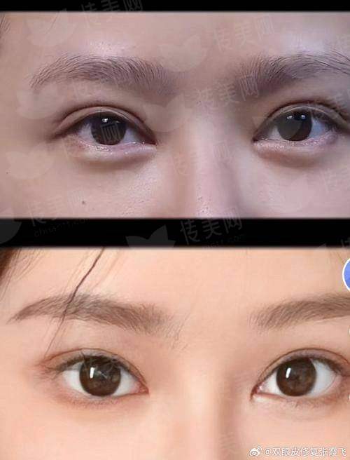 罗通贵医生的眼修复在成都新华医院备受好评，案例推荐与预约方式，新颜智尚小程序一键搞定！