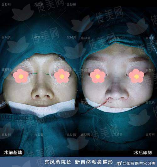 内蒙古呼和浩特亚太医疗美容医院周聪院长鼻修复怎么样？新颜智尚小程序预约，了解价格和案例！