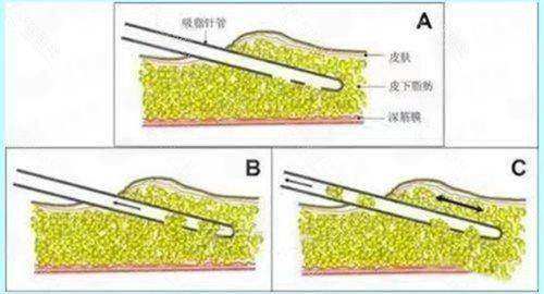 三、郑州芊美整形的隆鼻整形服务与流程是怎样的？