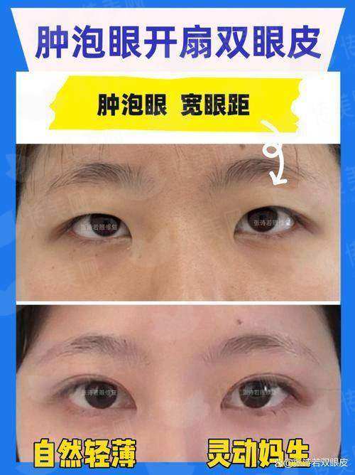 一、上海韩卓医疗美容的硅胶隆鼻技术怎么样？