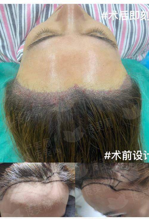三、在北京雍禾植发做发际线种植，成效和流程是怎样的？