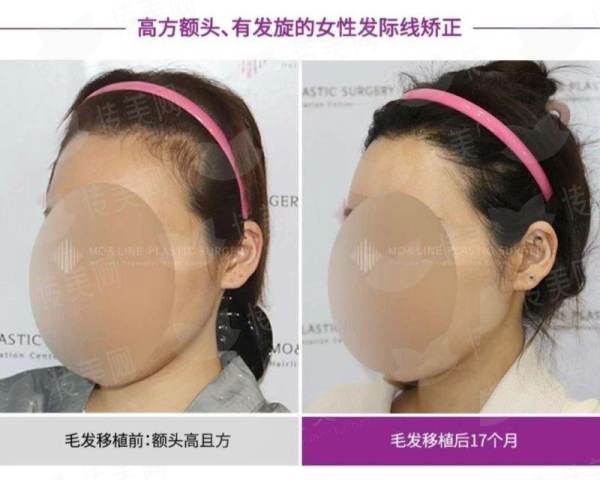 一、北京雍禾植发的发际线种植技术怎么样？
