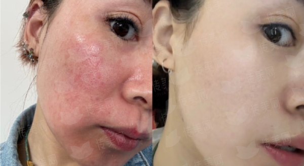赣州俪人医疗美容刘东医生：眶隔释放去眼袋案例&价格表一览-新颜智尚小程序一键预约！