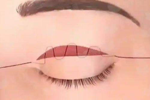 <strong>四、面对双眼皮修复，美亲们该如何理性决策并做好准备？</strong>