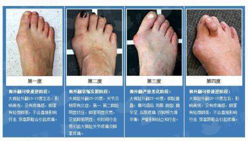 <strong>二、<strong>北京联合丽格第一整形医院的何医生peek下巴整形技术好在哪里？</strong></strong>