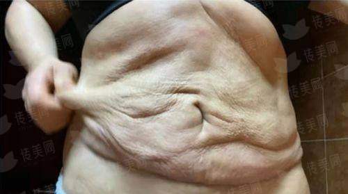 <strong>二、<strong>上海华美整形医院的何斌大腿吸脂修复期要多久？</strong></strong>