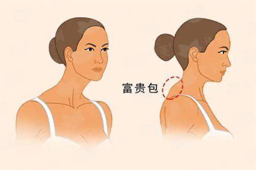 <strong>三、成都华生铂悦冯安民手术吸脂，安心与修复要注意什么？</strong>