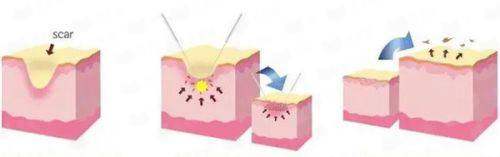 广州荔医余东文医生做奥美定异物取出怎么样？新颜智尚小程序预约及价格优惠攻略