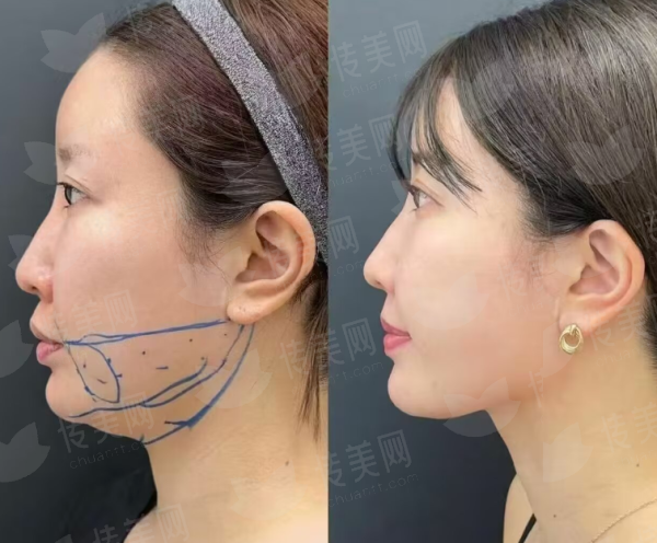 <strong>四、成都华生铂悦冯安民手术吸脂，如何选择与预约？</strong>