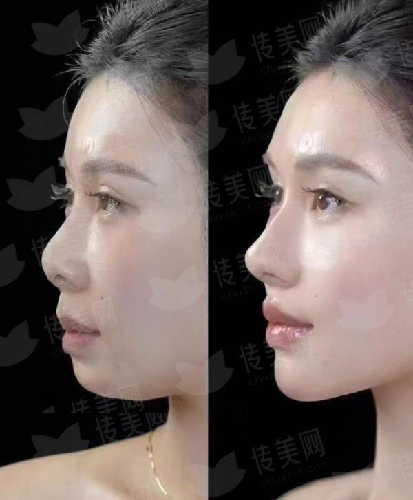 <strong>三、<strong>为什么冬季到邯郸华景做眼眉整形是明智之选？</strong></strong>