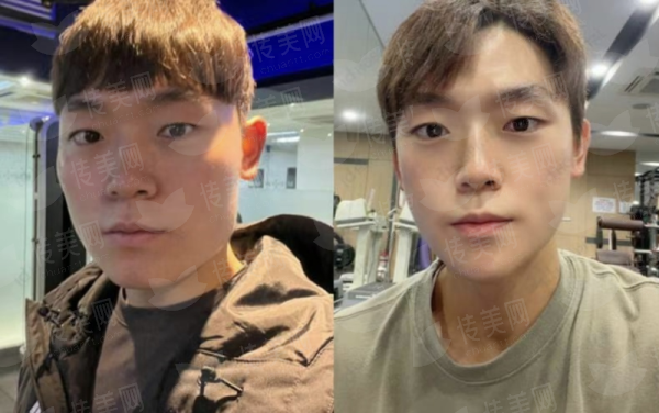 刘中策医生胸部下垂矫正真实案例分享，杭州维多利亚整形预约攻略（新颜智尚小程序）