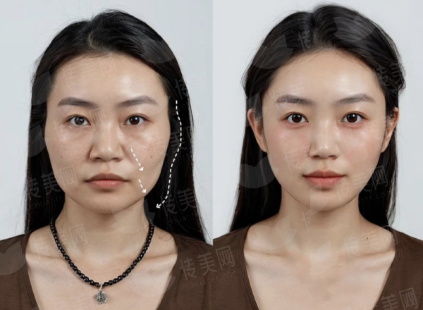 <strong>三、在兰州韩美做双眼皮价格贵吗？</strong>