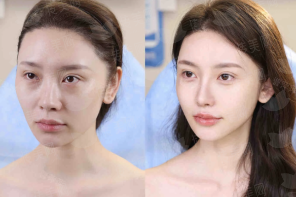 <strong>四、<strong>上海华美整形医院的何斌大腿吸脂如何预约与面诊？</strong></strong>