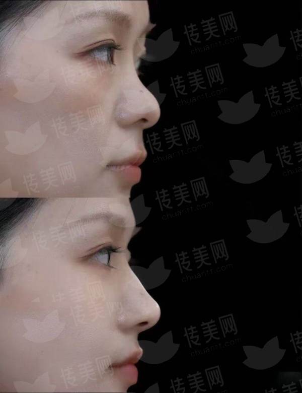<strong>三、北京碧莲盛植发的发际线种植价格与流程是怎样的？</strong>