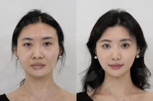 郑州芳艺整形医院关博瘦脸针口碑如何？新颜智尚预约，看真实案例与价格