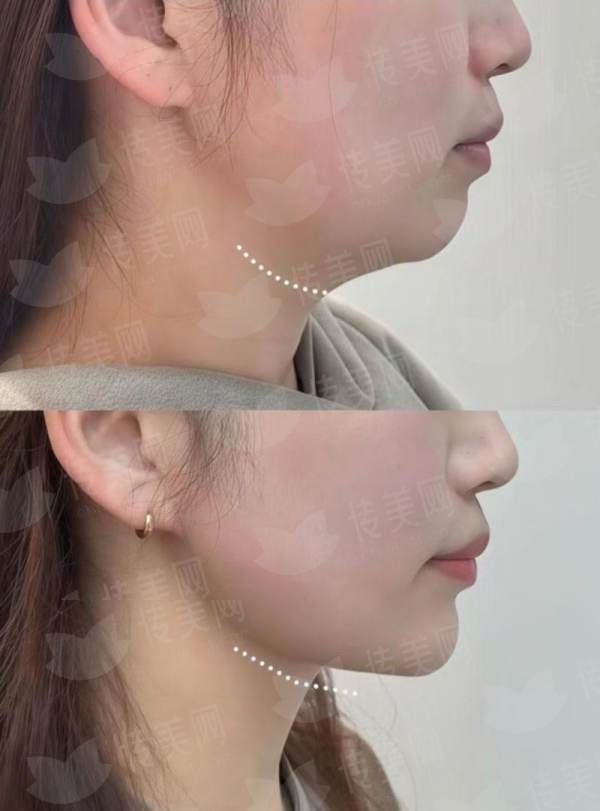 <strong>二、<strong>郑州芳艺整形医院的关博瘦脸针成效能维持多久？</strong></strong>