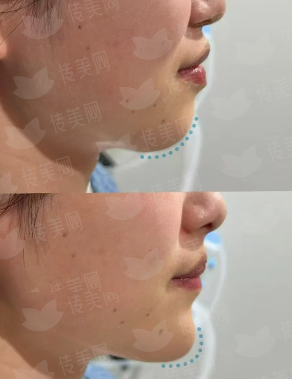 <strong>三、在上海选择关灿彬超声炮，价格与成效如何平衡？</strong>