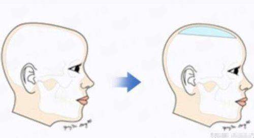 <strong>二、选择深圳南雅医疗美容门诊部的刘富增医生做无痕筋膜手术，需要了解哪些关键信息？</strong>