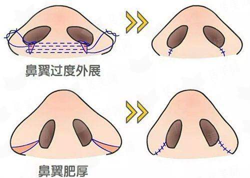 兰州华美（亚韩）刘强医生硅胶隆鼻口碑如何？预约走新颜智尚小程序