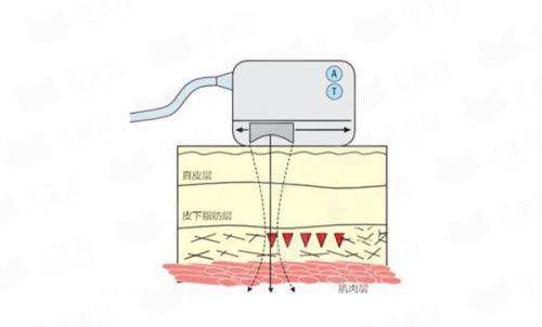 <strong>二、株洲河东华美的脱毛技术具体好在哪里？</strong>