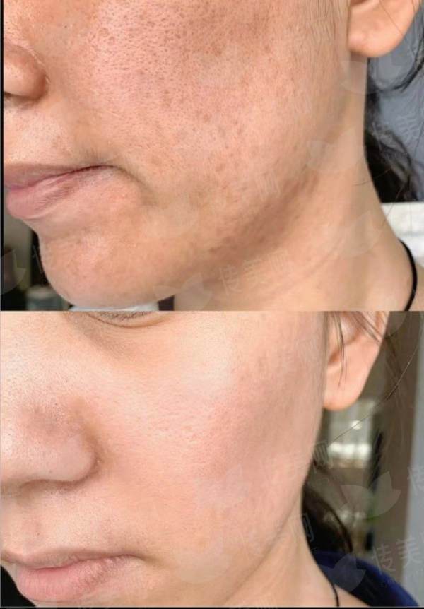 <strong>四、兰州华美（亚韩）的刘强硅胶假体隆鼻如何选择与预约？</strong>