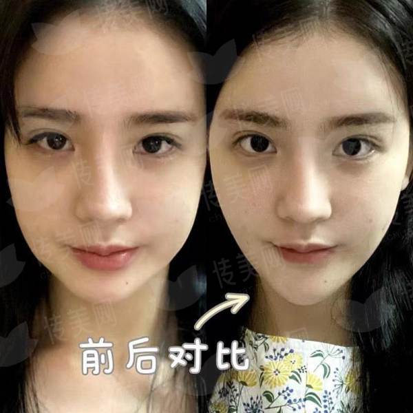 <strong>四、<strong>成都恒博植发医院眉毛种植术后成效与口碑如何选择？</strong></strong>