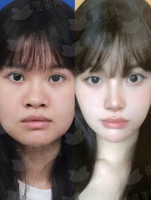 刘常菊医生皮肤激光怎么样？预约方式：（新颜智尚小程序）及价格了解