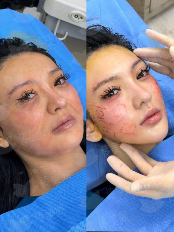 <strong>二、成都华美紫馨医美口腔医院的祛眼袋技术好吗？</strong>