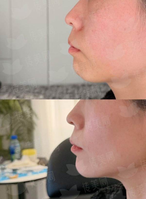 <strong>三、<strong>成都恒博植发医院的眉毛种植价格与流程是怎样的？</strong></strong>