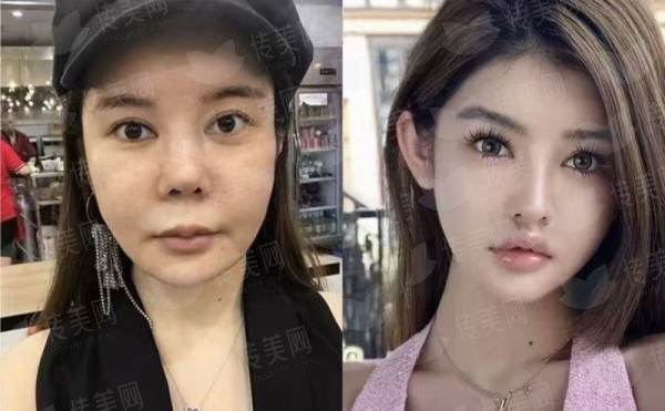 <strong>三、武汉五洲整形外科医院的童颜针，成效和护理要注意什么？</strong>