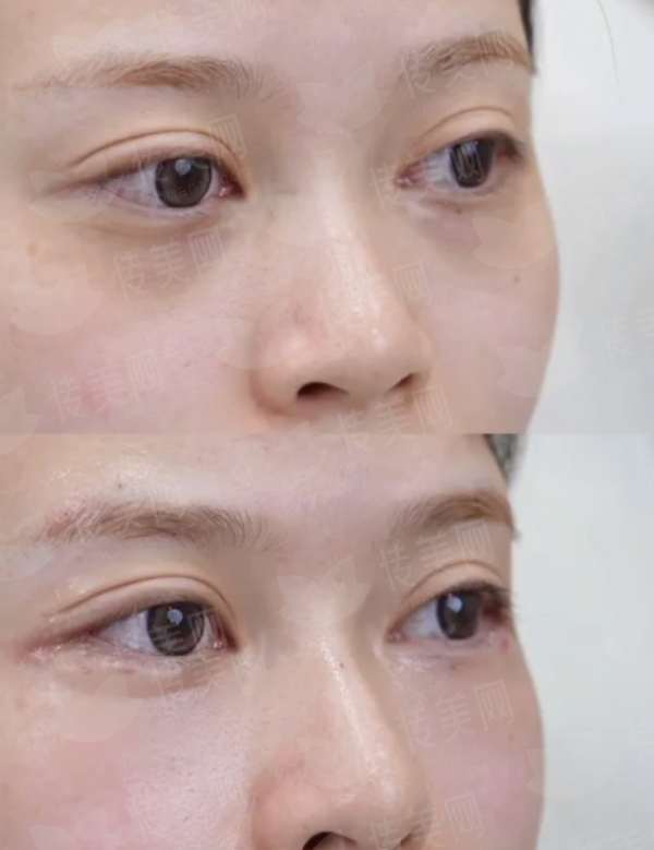 <strong>三、成都大麦植发医疗连锁的毛发种植价格与成效怎么样？</strong>