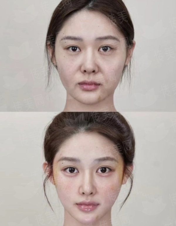 <strong>三、保定珍润医疗美容门诊部的刘宁除皱针价格贵不贵？</strong>