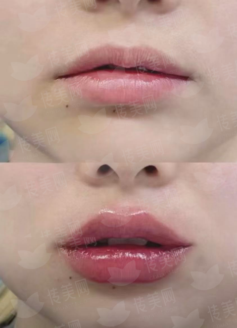 <strong>二、深圳富华整形刘少英针剂项目有哪些特色与优势？</strong>