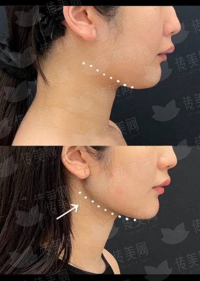 深圳南雅刘富增医生无痕筋膜手术效果咋样？价格优惠攻略与预约方式详解，新颜智尚小程序可约