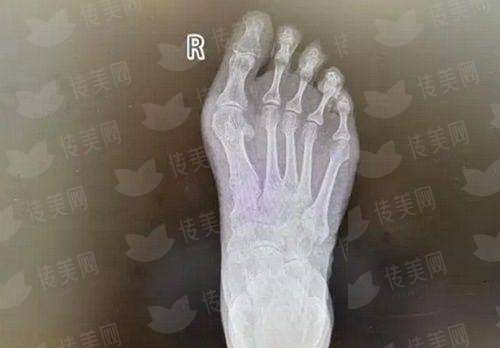 平顶山星美医疗美容全切双眼皮做的怎么样？真实用户反馈与特色技术解析，小程序预约