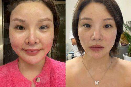 <strong>三、在浙江杭州整形医院做拉皮，价格和成效怎么样？</strong>