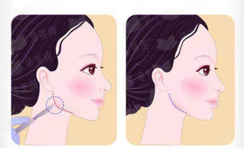 <strong>二、抚州梦婷医疗美容的吸脂适合哪些部位和人群？</strong>