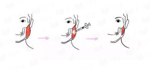 <strong>三、在四川成都现代整形医院做腹壁成型，价格、修复与风险须知</strong>