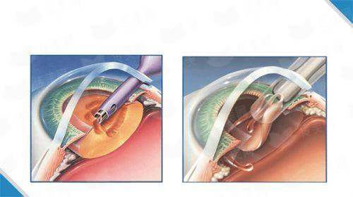 <strong>四、<strong>如何选择与预约徐州和平妇产医院的双眼皮手术？</strong></strong>