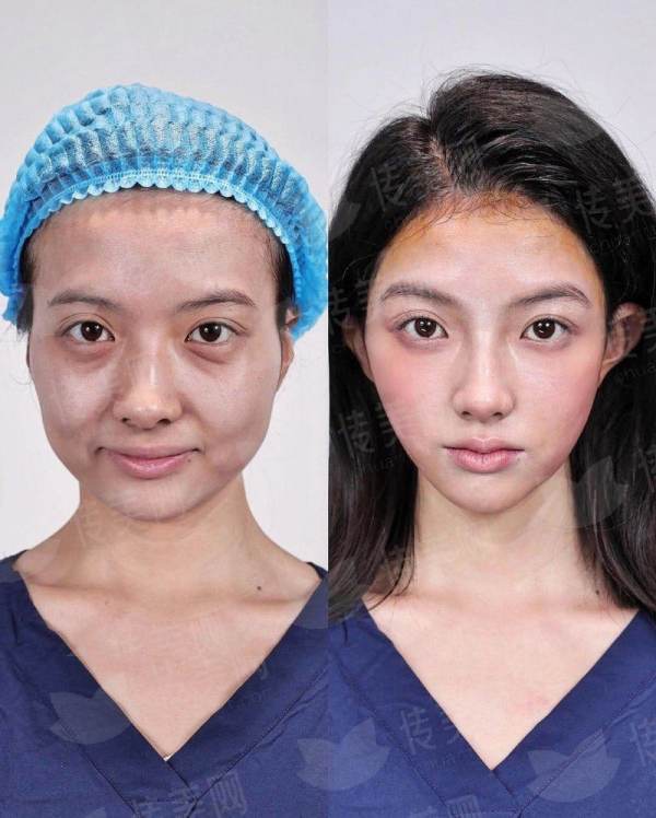 <strong>二、浙江杭州整形医院的高难度鼻修复技术，有什么独到之处？</strong>