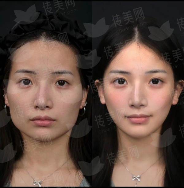 <strong>二、重庆明好医院植发的微针植发适合哪些人？价格贵不贵？</strong>