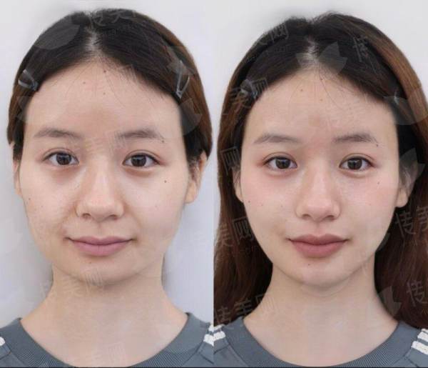 <strong>三、在沈阳腾采医疗美容做吸脂，从面诊到修复的全流程是怎样的？</strong>