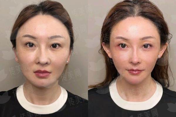 温州星范陈德裕双眼皮特色技术剖析，附真实案例对比与医院介绍，新颜智尚小程序一键约