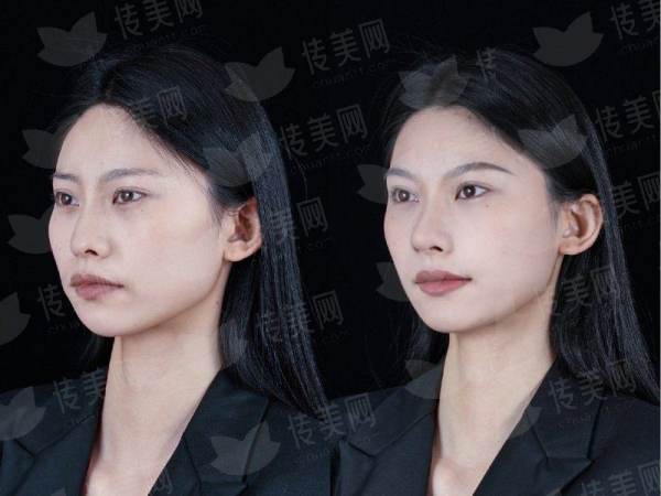 <strong>四、隆鼻术后护理与抚州梦婷医疗美容的服务保护</strong>