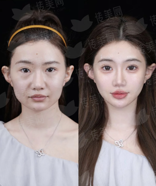 想找蔡鹏武院长做隆胸？邯郸丽人整形详细预约流程，附特色技术介绍