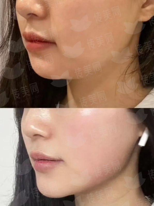 <strong>三、<strong>在东莞做鼻翼缩小，术前术后要注意什么？</strong></strong>