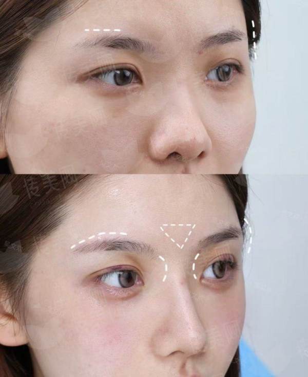 双眼皮整形选东莞星采，医院介绍与预约方式一览，新颜智尚小程序一键搞定