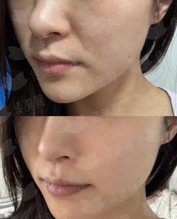 <strong>二、浙江杭州整形医院的拉皮手术技术有什么特别之处？</strong>